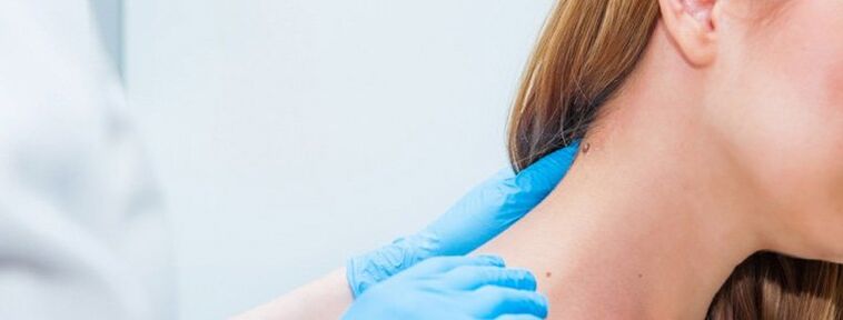 Papilloma no pescoço