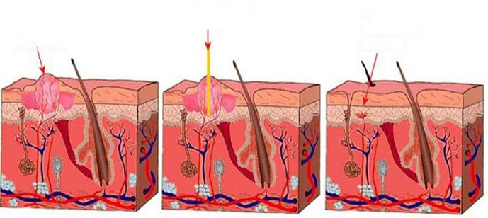 Como o laser funciona nos papilomas