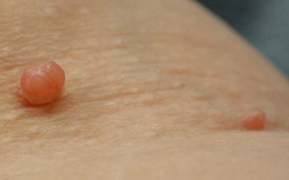 papiloma no corpo