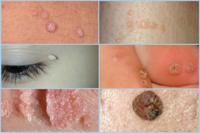 tipos de papilomas no rosto e no corpo