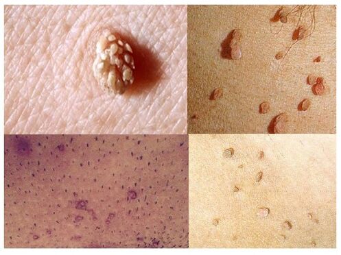 verrugas genitais no corpo