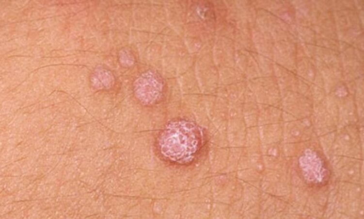 HPV leva ao aparecimento de papilomas cutâneos