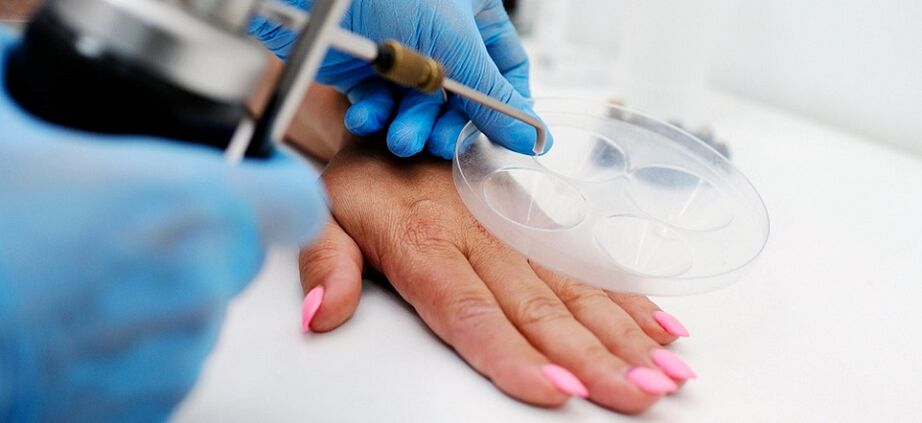 remoção profissional de verrugas disponível