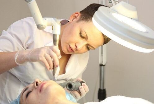 remoção de papilomavírus humano com laser