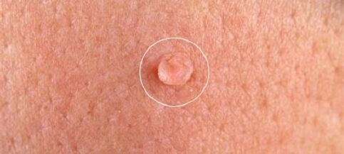verrugas genitais no corpo