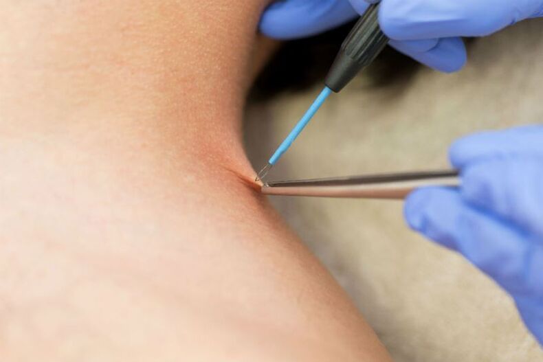 O procedimento para remoção de papiloma por eletrocoagulação