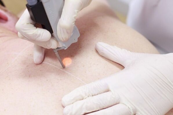 Um método popular para remover papilomas com laser