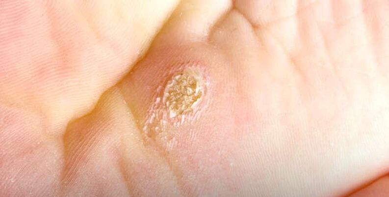 Verruga plantar (verruga espinhal)