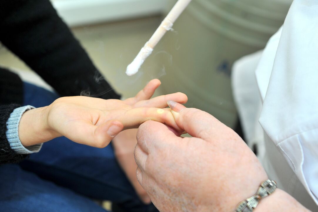 período de recuperação após a remoção da verruga