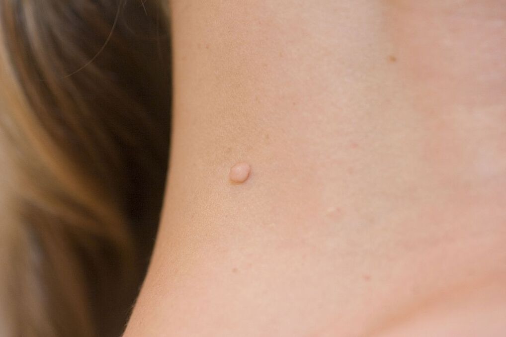 Sintomas do HPV
