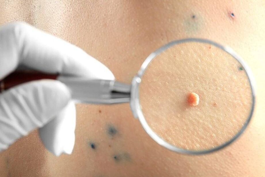 Tratamento do HPV