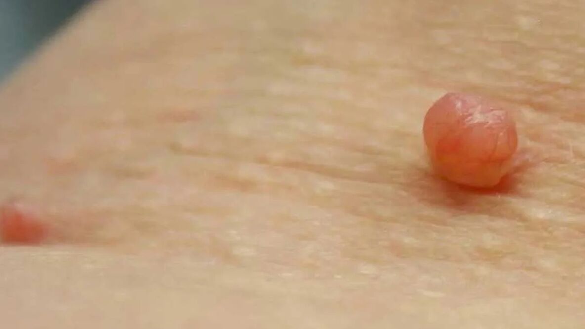 remoção de papilomas em casa