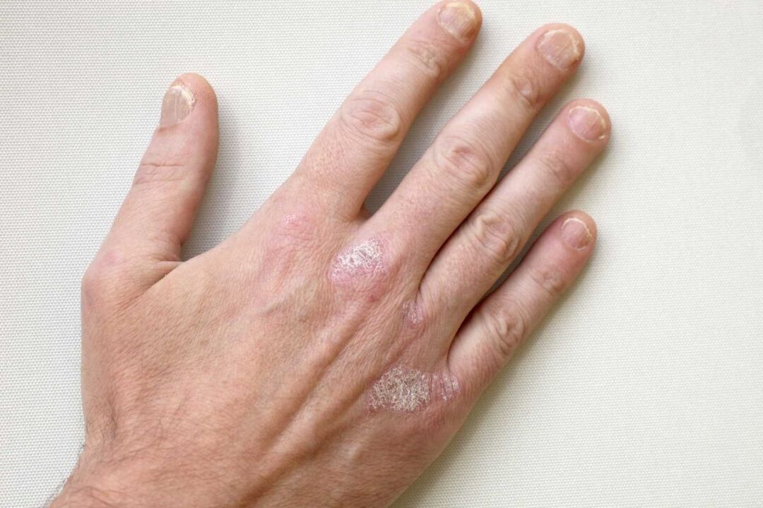 psoríase nas mãos de um homem tratamento com creme Keramin