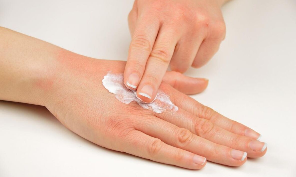 tratamento da psoríase com creme Keramin
